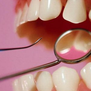 Как може да премахнем зъбният камък без помощта на зъболекар ?